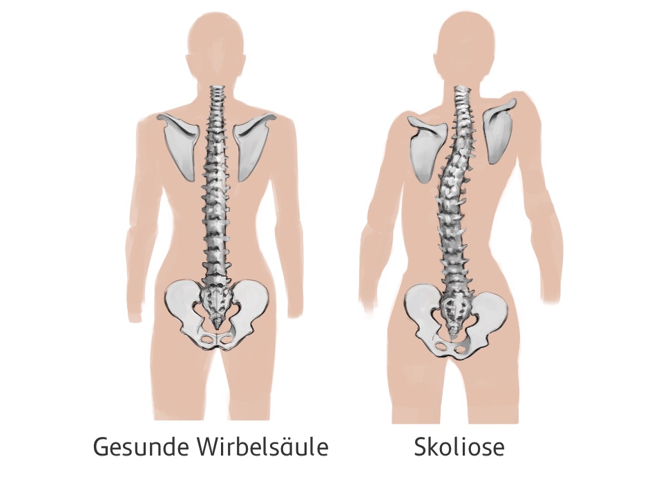 Zwei grafisch dargestelle Rücken, eine gesunde Wirbelsäule, und eine geschlungene Wiebelsäule mit Skoliose. Abgebildet in einem angedeuteten weiblichen Körper, inklusive Schulterblätter.