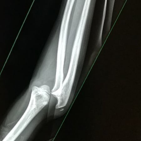 Röntgenbild einer Verrenkung des Unterarms