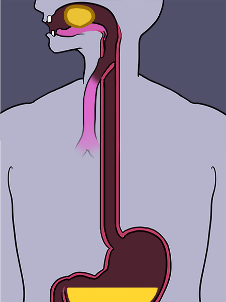 Die persistaltische Bewegung der Speiseröhre schiebt einen Klumpen Speisebrei Richtung Magen.