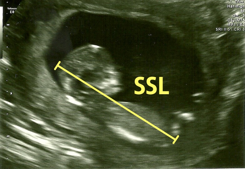 Ultraschallbild mit eingezeichneter Scheitel-Steiß-Länge, die vom Kopf bis zum Steißbein des ungeborenen Kindes gemessen wird.